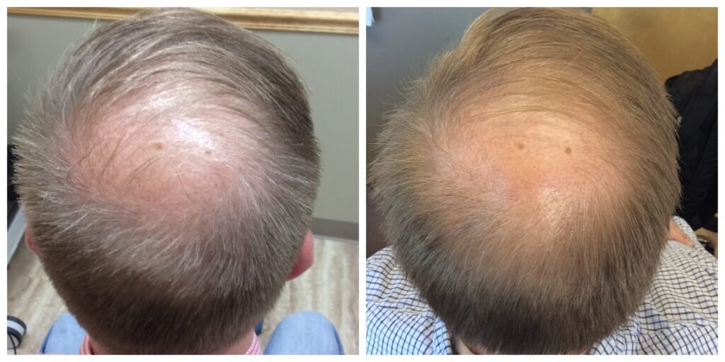 Hair Loss Treatment (PRP) 4 HI - Copy