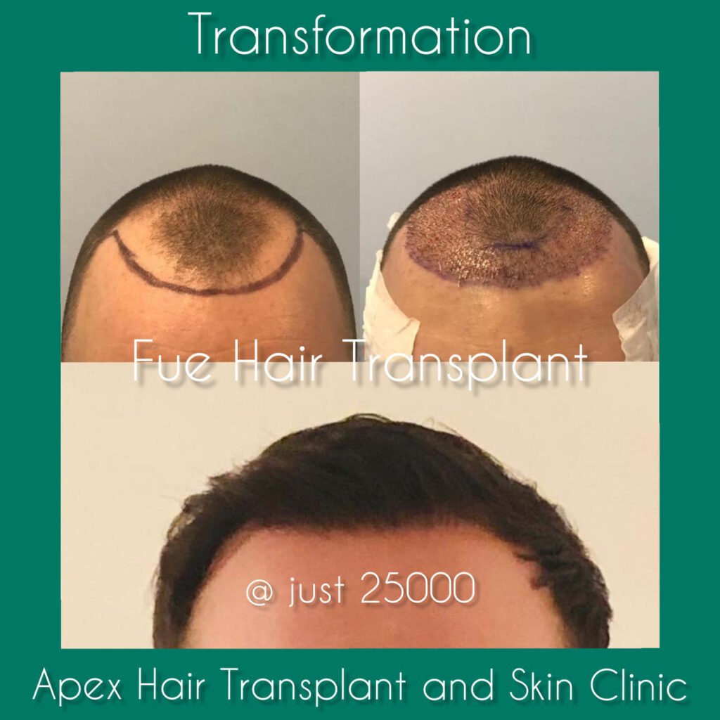 Apex Hair Transplant Results