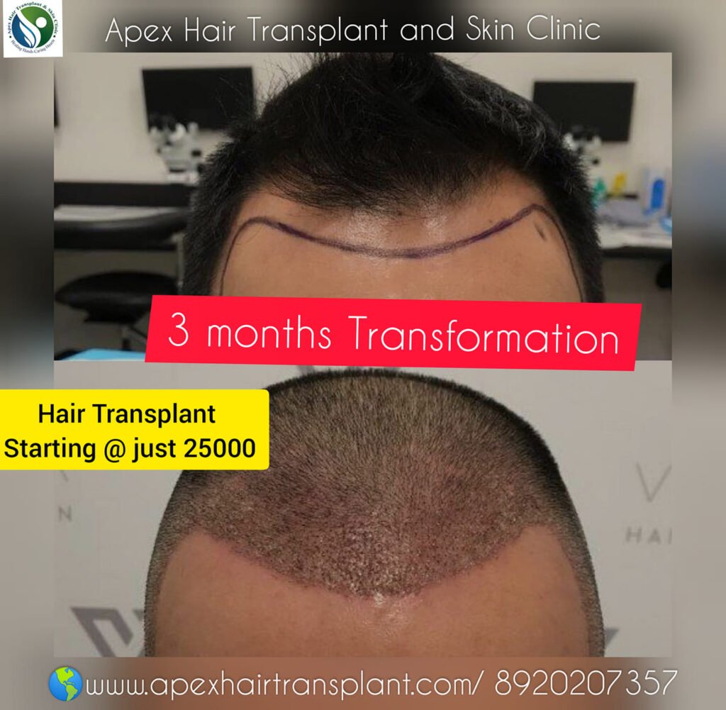 Apex Hair Transplant Results