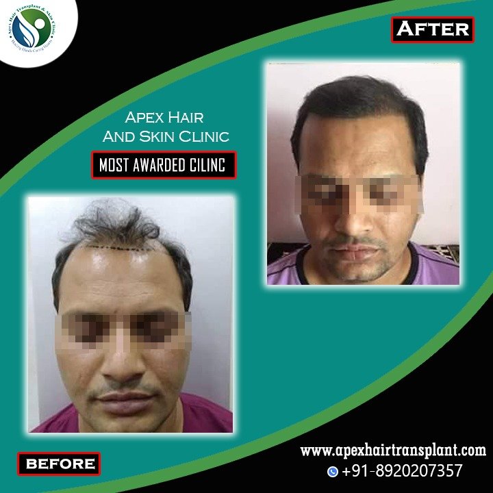 Best hair transplant clinic in noida & Delhi NCR