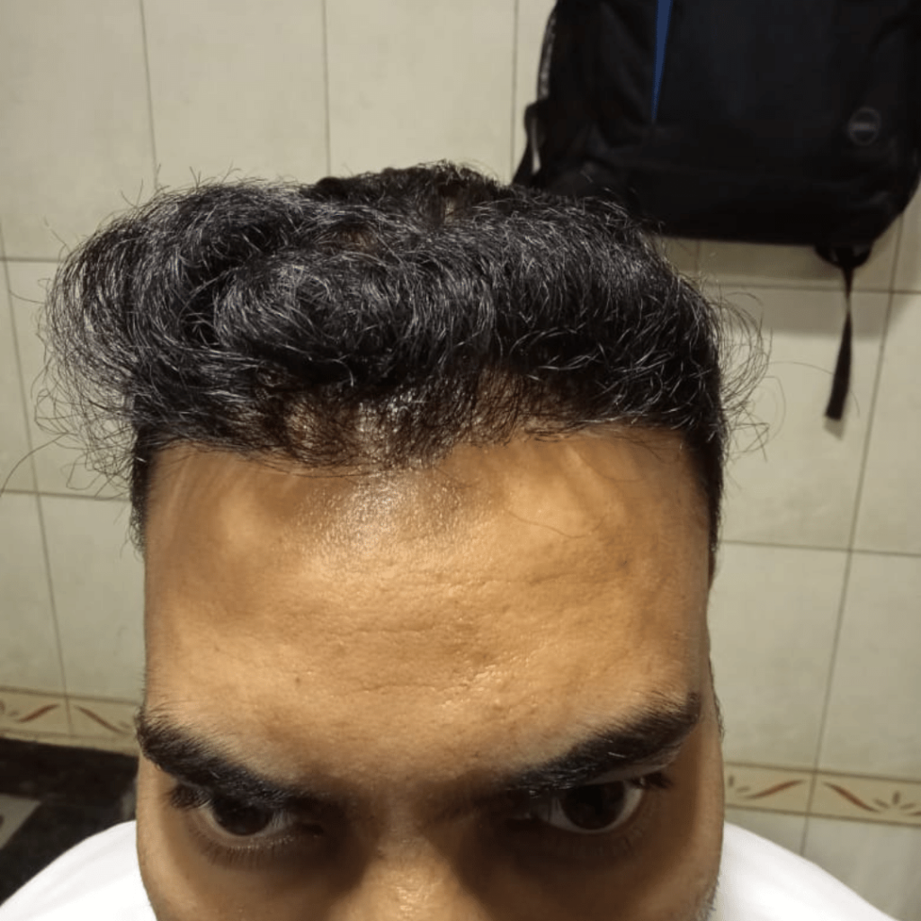 Apex Hair and Skin Clinic Noida